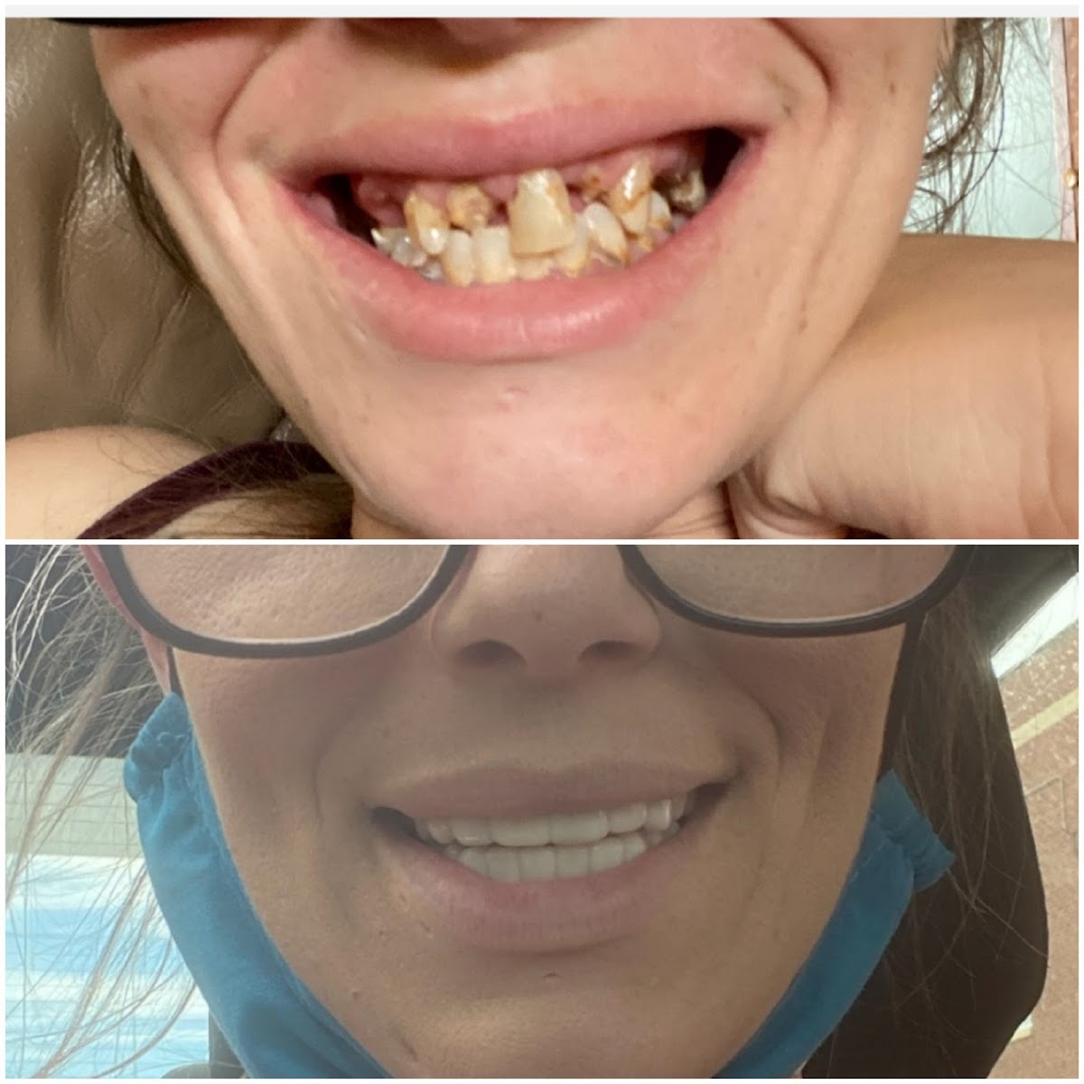 Removable Veneers Usa - Snap on Veneers photo 2