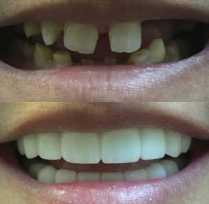 Removable Veneers Usa - Snap on Veneers photo 3