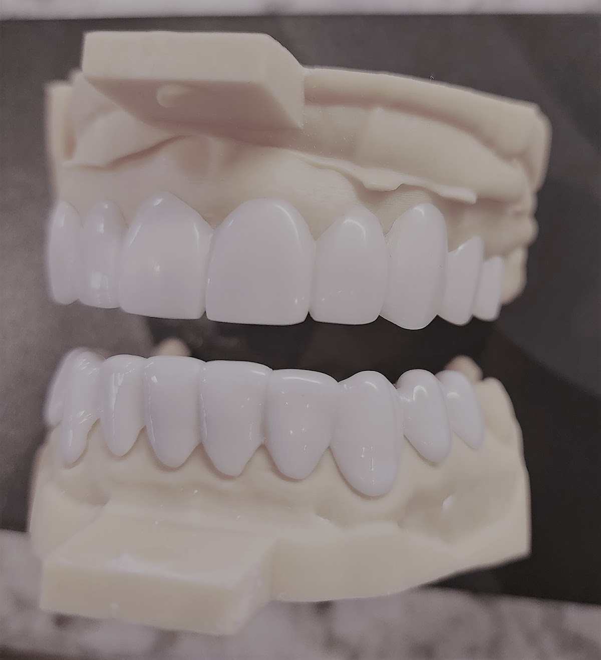 Removable Veneers Usa - Snap on Veneers photo 4