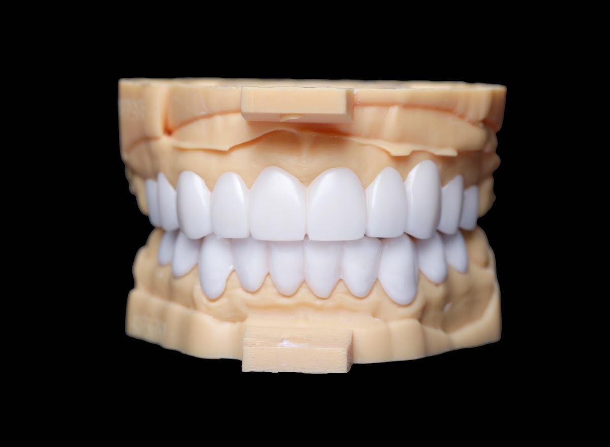 Removable Veneers Usa - Snap on Veneers photo 6