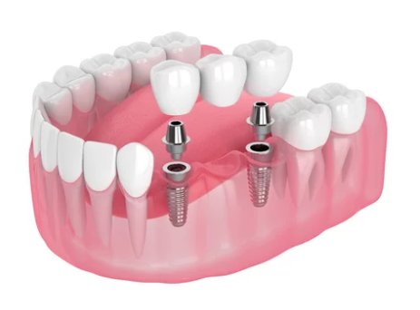 Harrison Implant and Family Dentistry photo 4