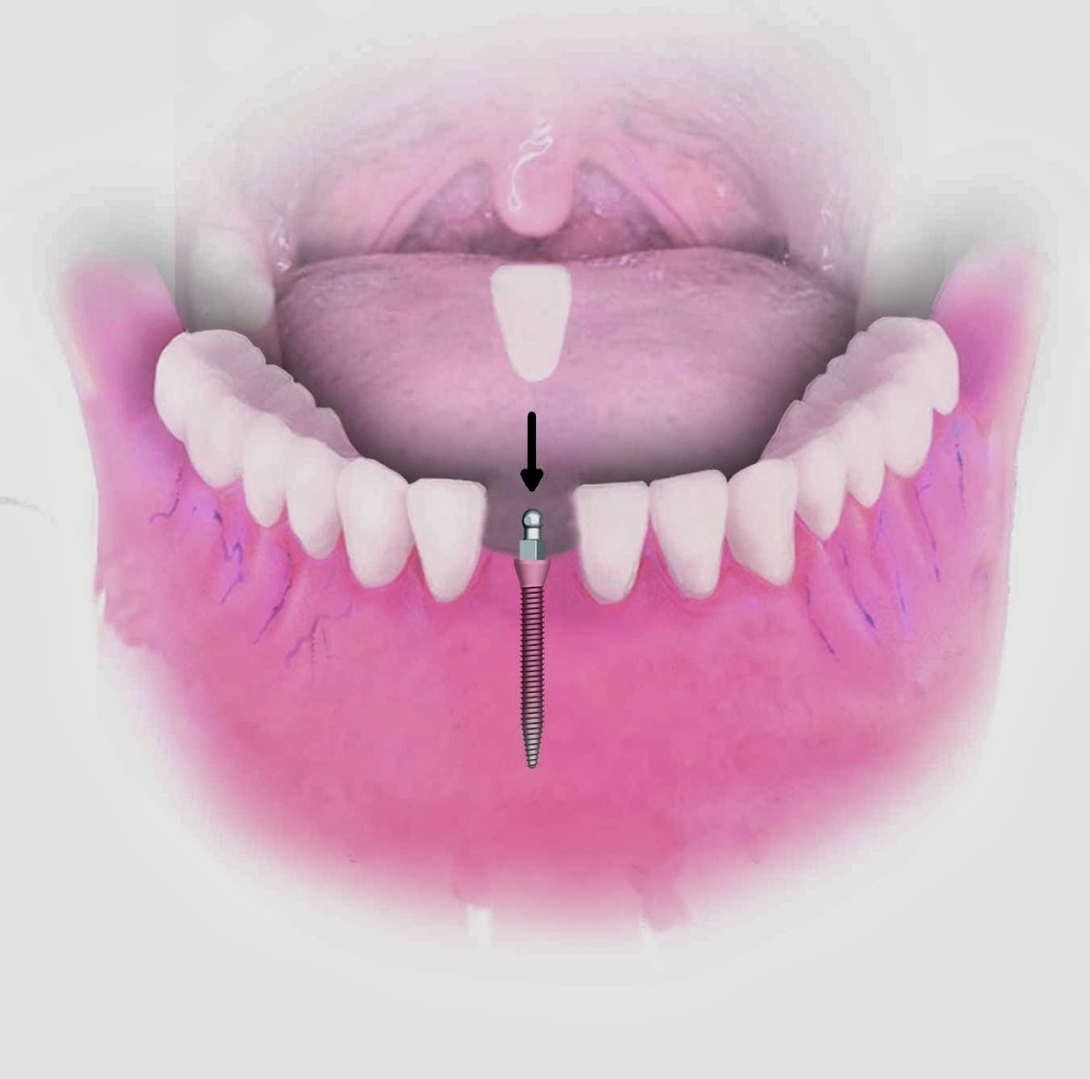 Dental Implant Solutions Decatur Mi photo 1