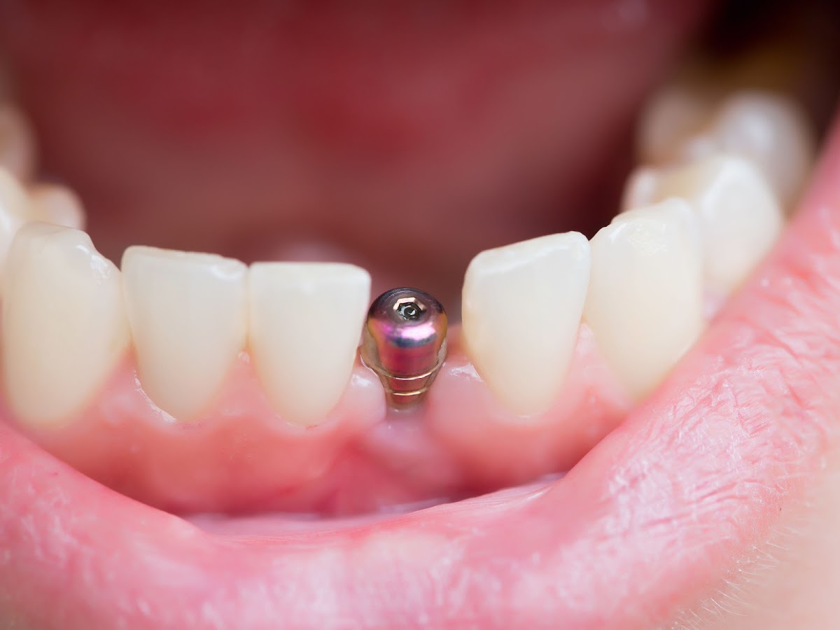 Pittsburgh Dental Implants and Periodontics photo 2