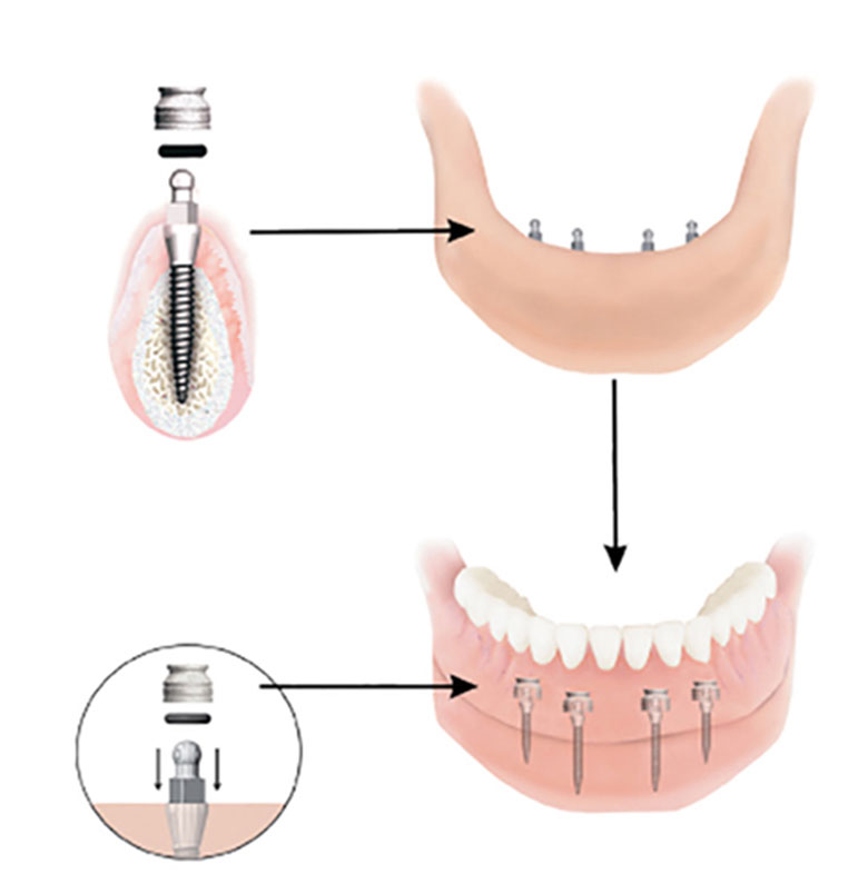 Dental Implant Solutions of Wichita Ks photo 4