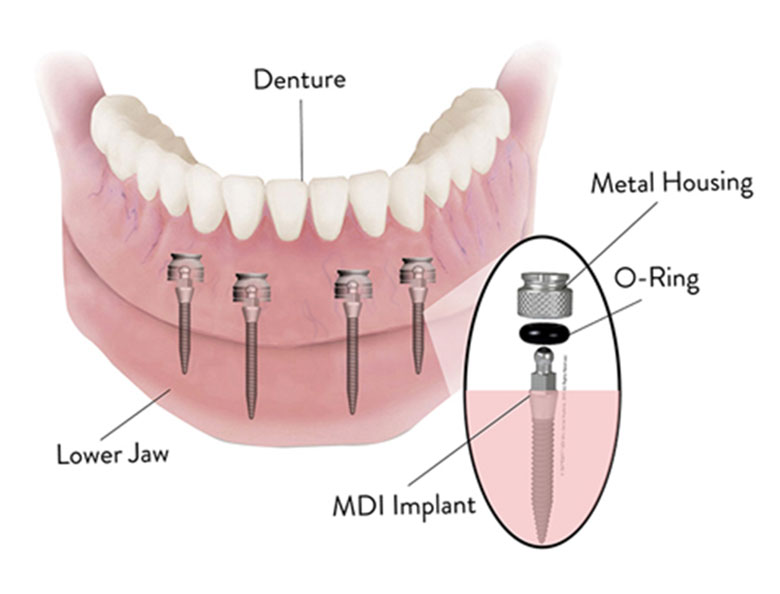 Dental Implant Solutions of Wichita Ks photo 5