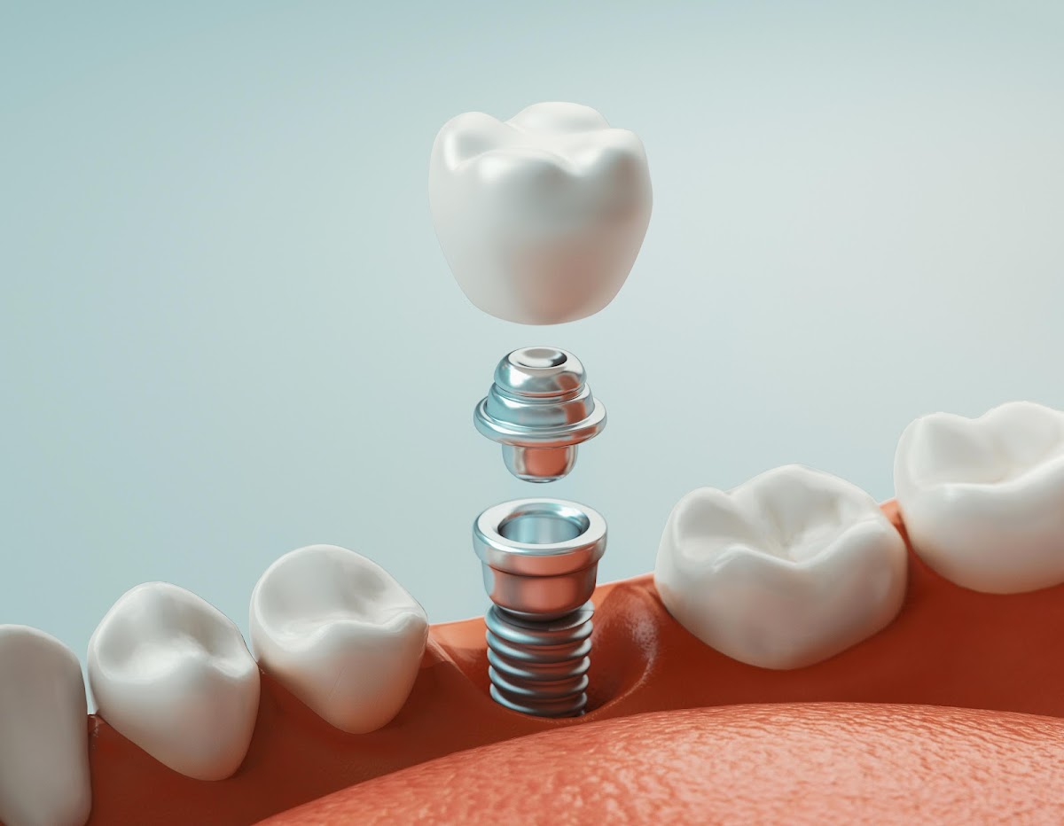 Apex Implant Center photo 1