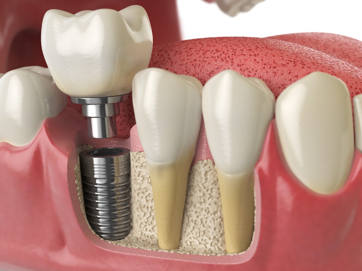Saltman Implantology & Oral Surgery photo 5