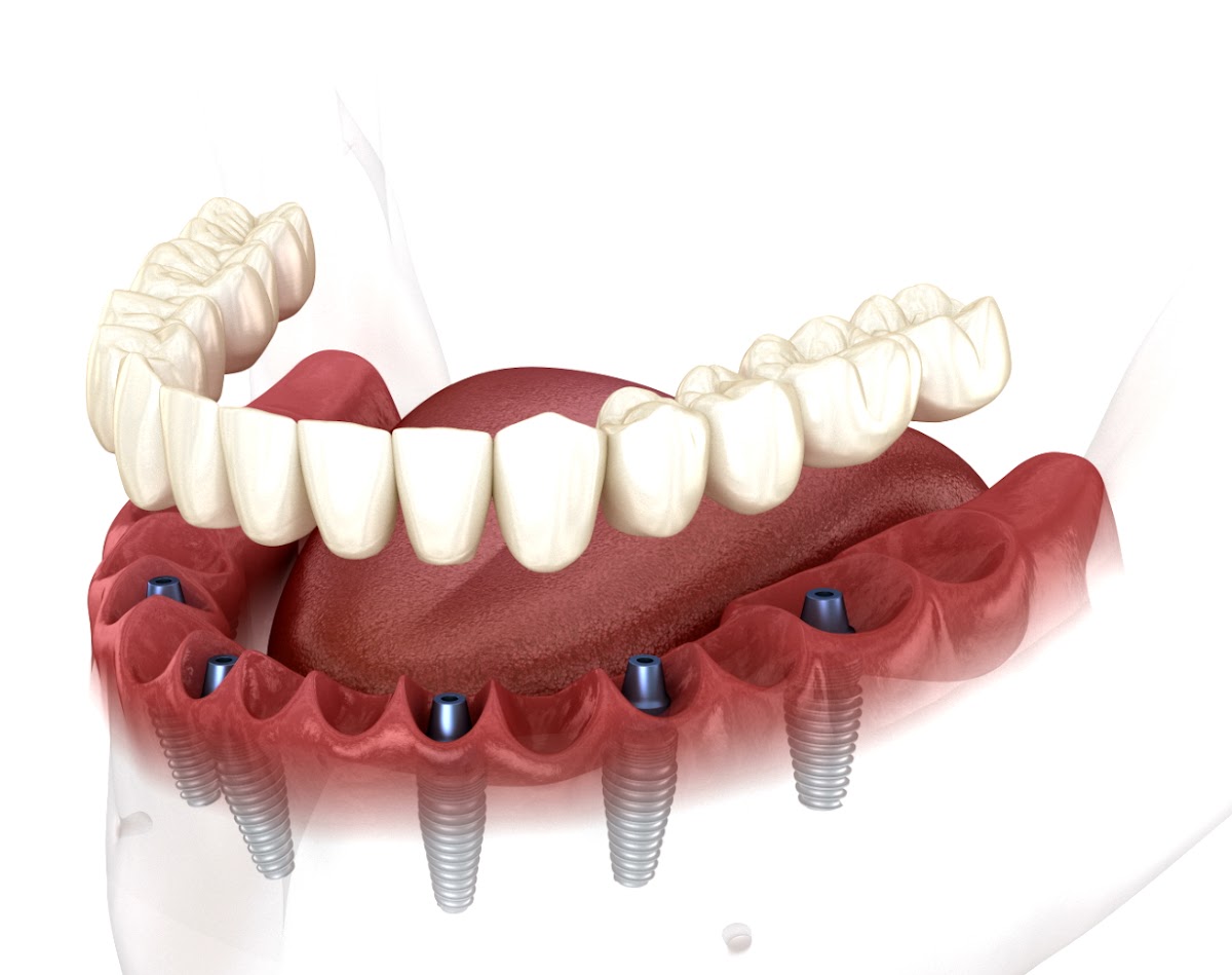 Memphis Dental Implants Center photo 1