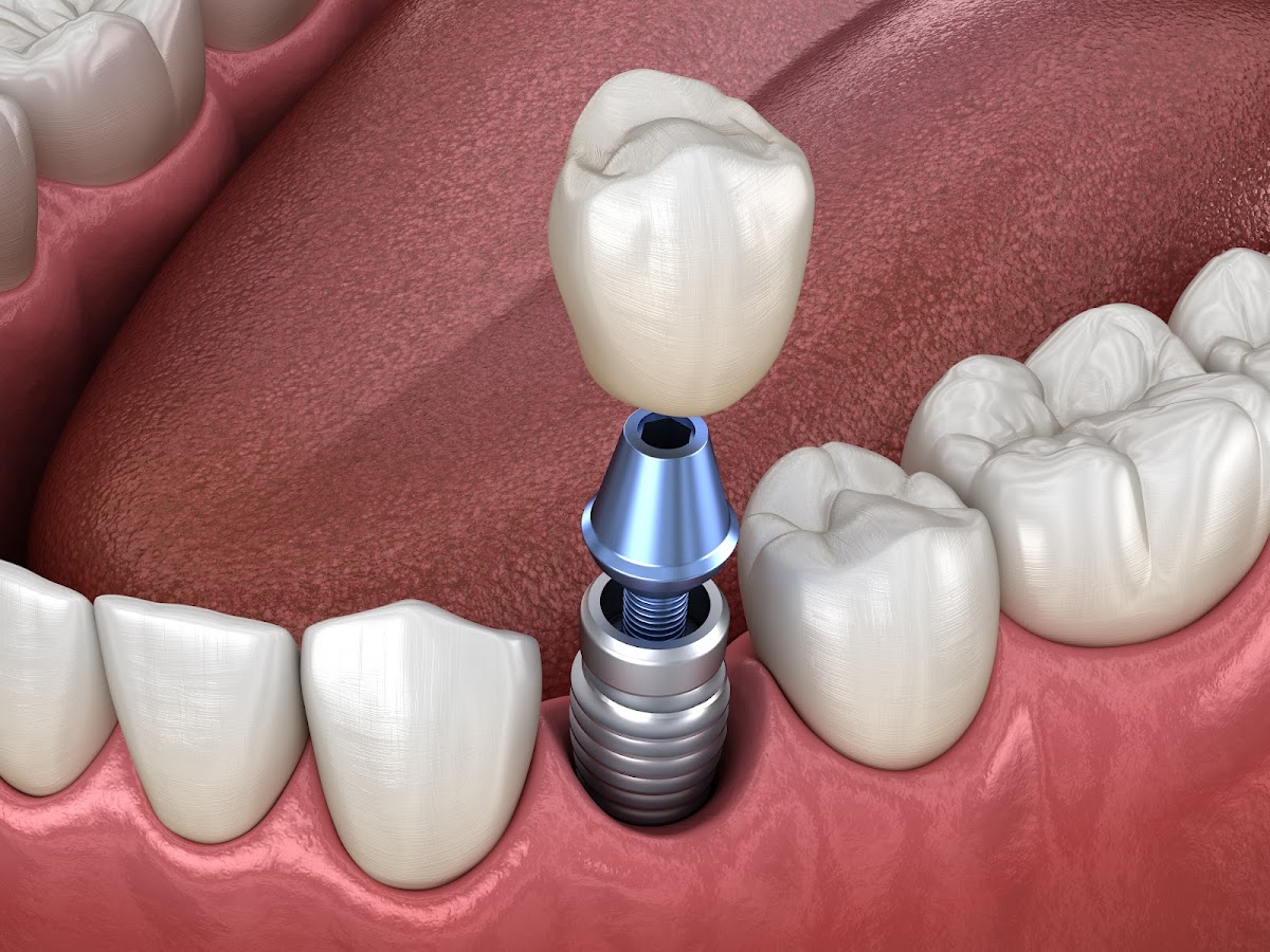 Memphis Dental Implants Center photo 2