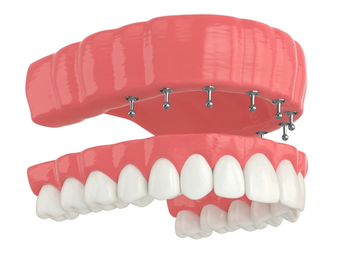 Memphis Dental Implants Center photo 6