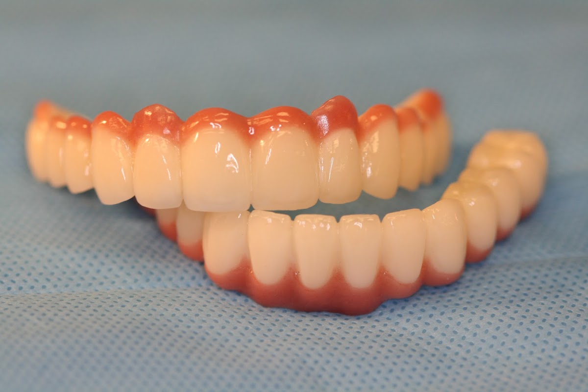 K1 Implant Choice photo 5