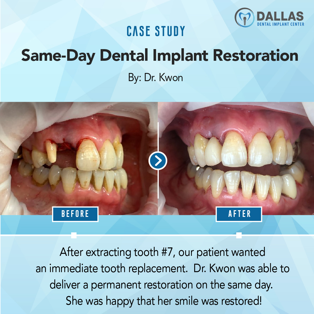 Dallas Dental Implant Center photo 4