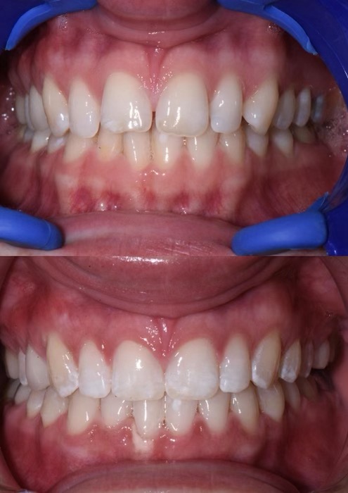 Stabili-teeth® photo 2