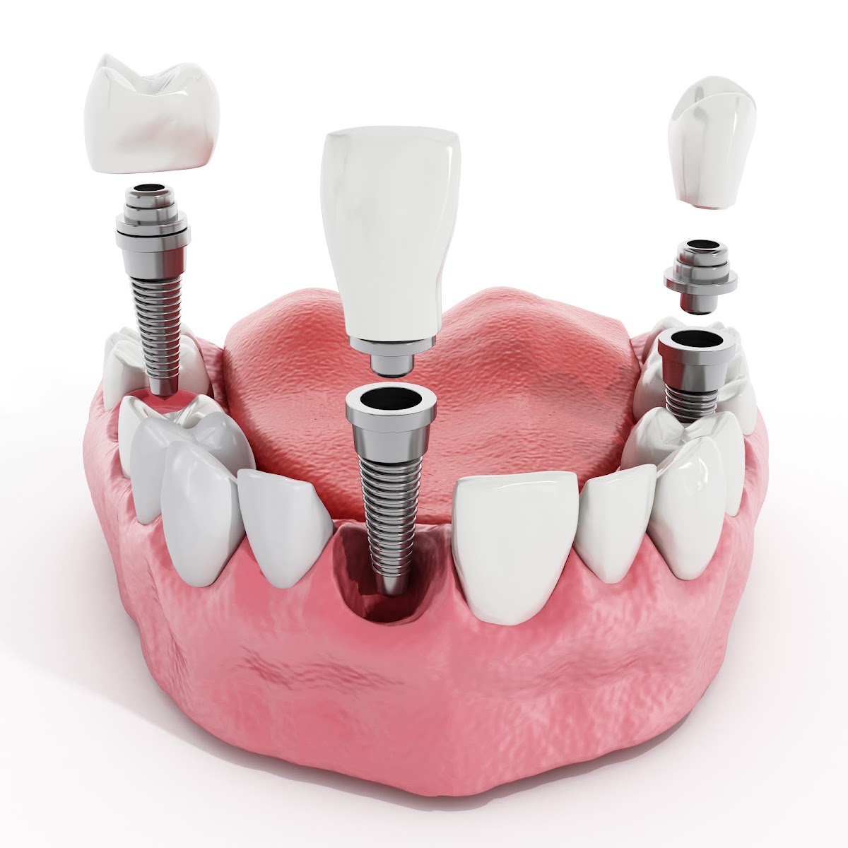Perfect Smile and Implant Center | Dental Clinic photo 3