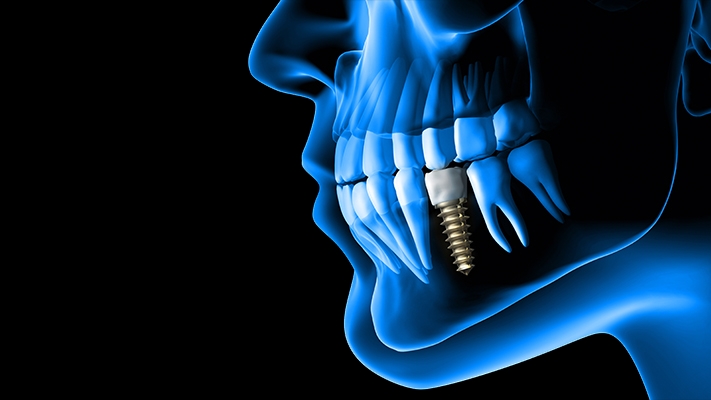Dental Implants Institute Of The West Coast photo 1