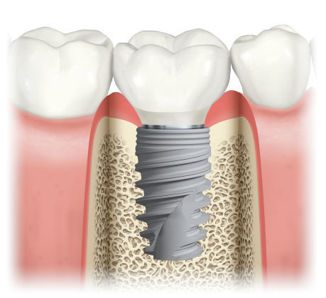 Sani Periodontics and Implant Dentistry - Www.thetravelingperiodontist.com photo 5