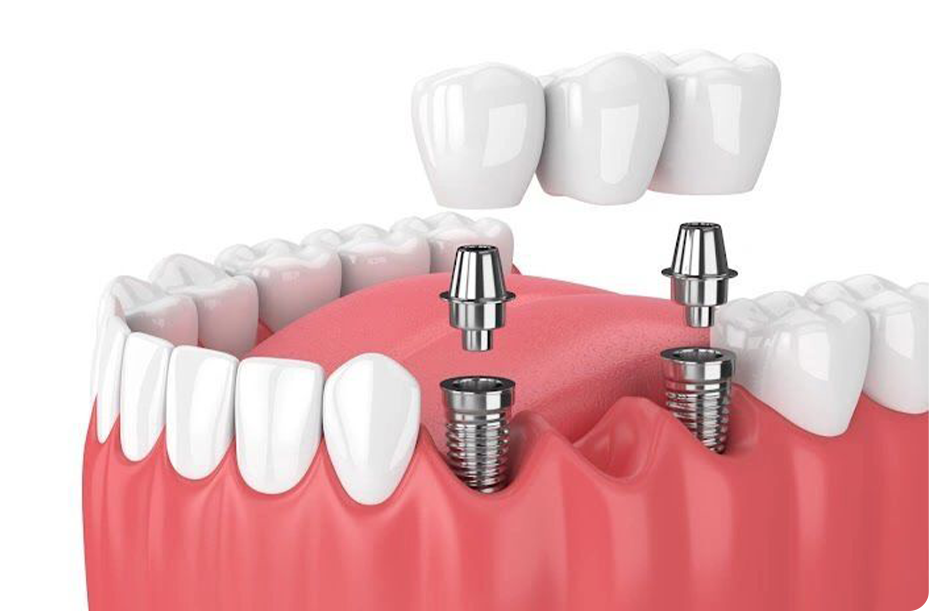 Implantation Dentistry photo 6