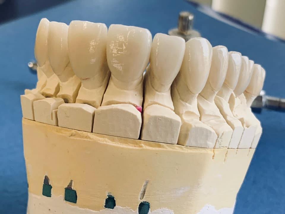 Uptown Dental Lab- All on 4 Dental Implants Houston | Dental Labs in Houston Texas photo 4