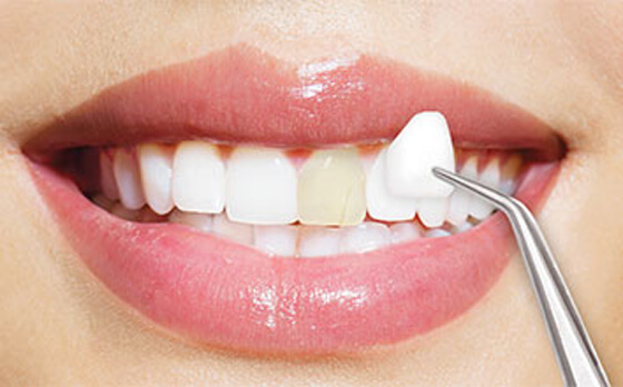 Uptown Dental Lab- All on 4 Dental Implants Houston | Dental Labs in Houston Texas photo 6