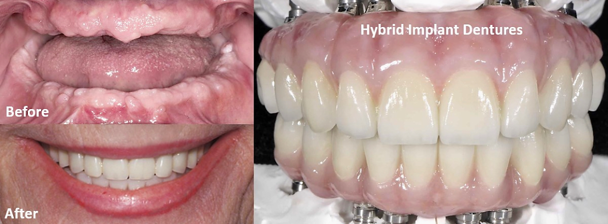 Affordable Dental Implant Excellence photo 6