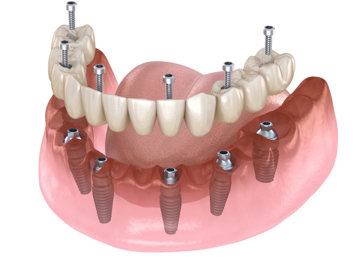 Smilecentric - General, Cosmetic & Implant Dentistry photo 5