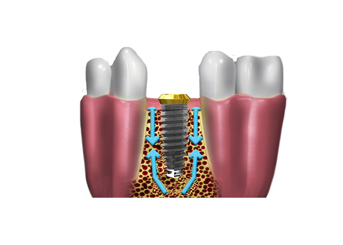 Oco Biomedical - Dental Implant Manufacturer photo 3