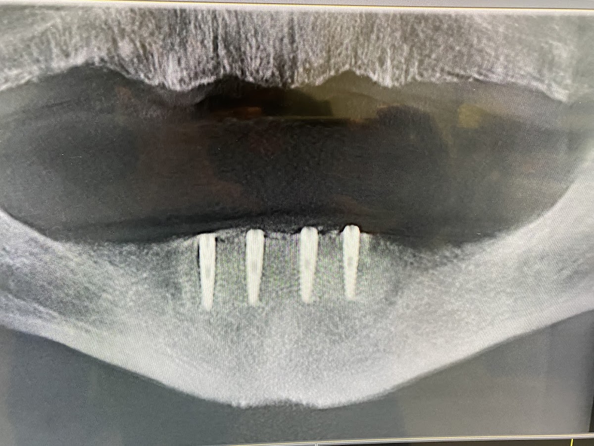 Best Value Dentures and Implants Tamarac photo 2