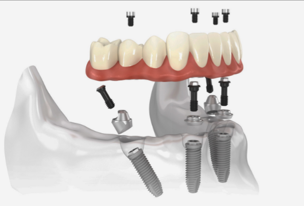 Kent Dental Implant Center photo 3