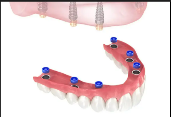 Kent Dental Implant Center photo 5